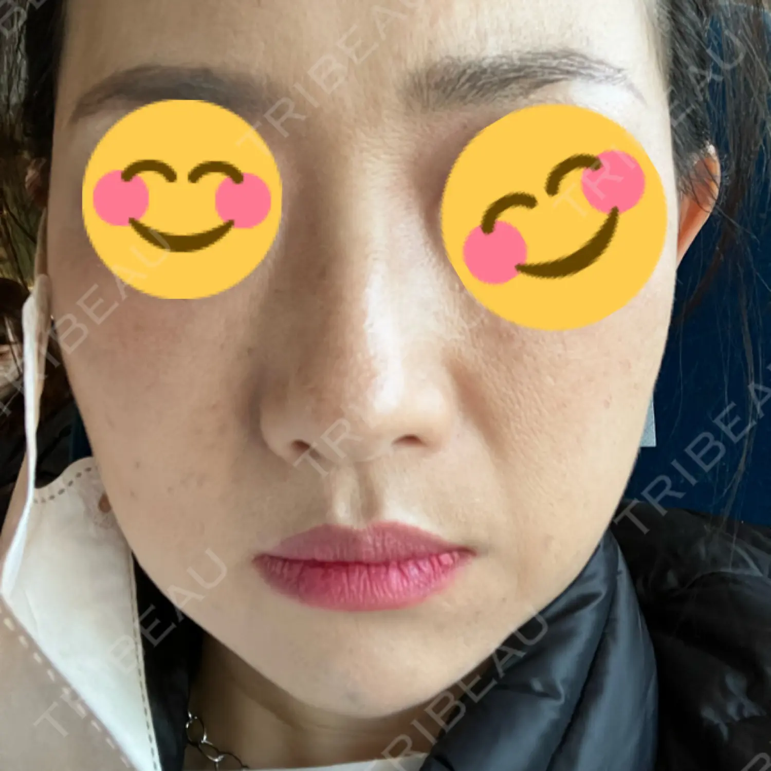 施術前の写真