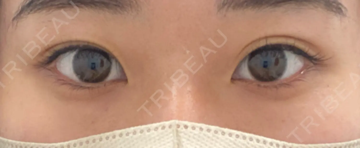 施術前の写真