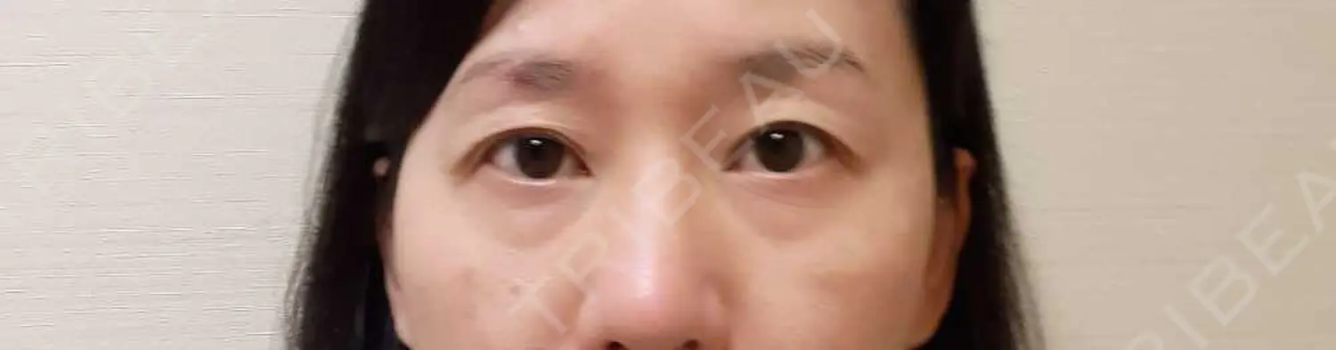 施術前の写真