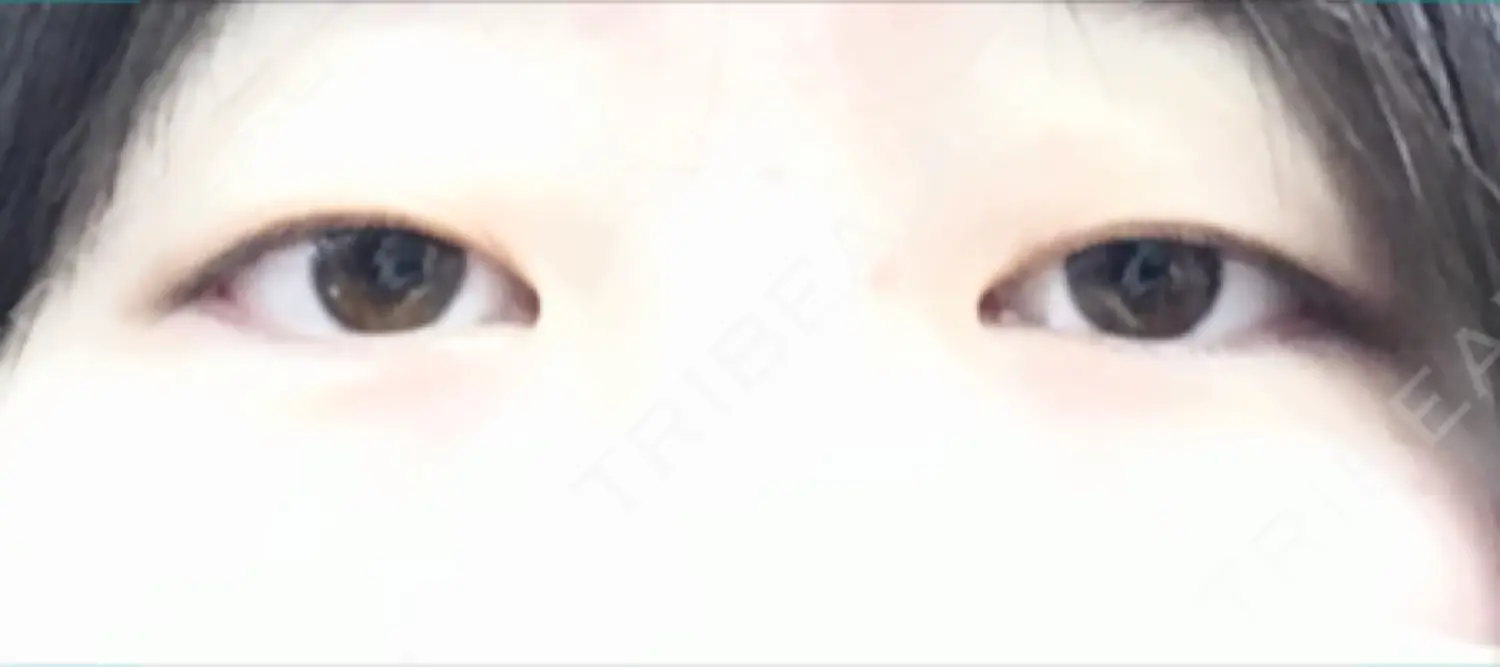 施術前の写真