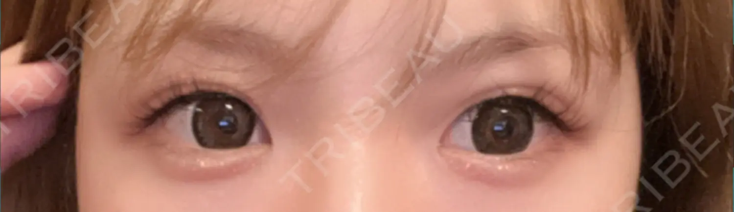 施術前の写真