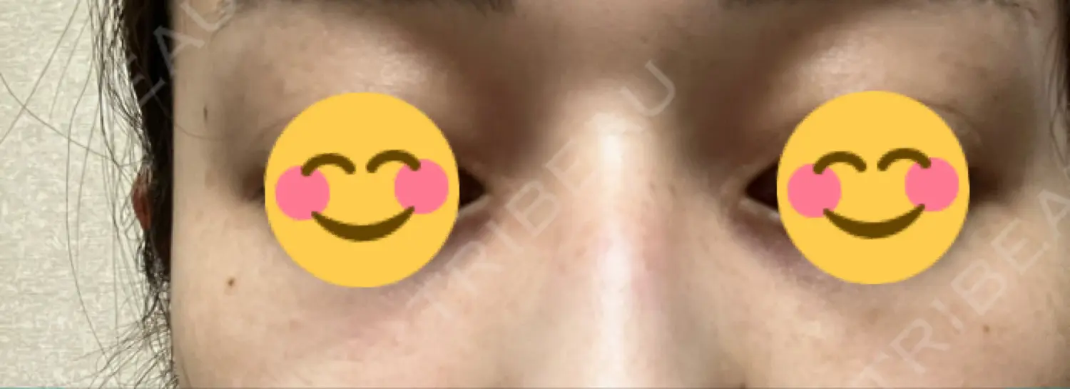 施術前の写真