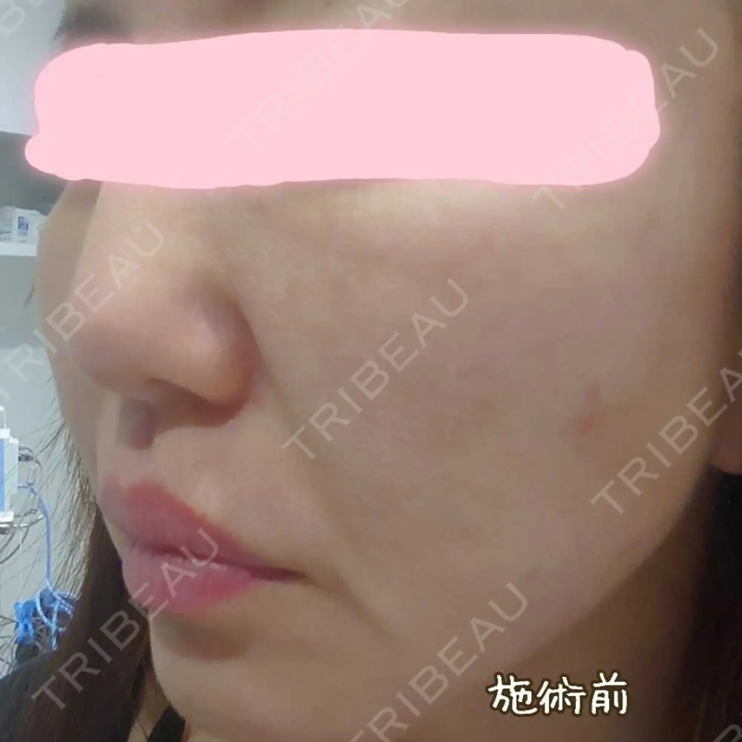 施術前の写真