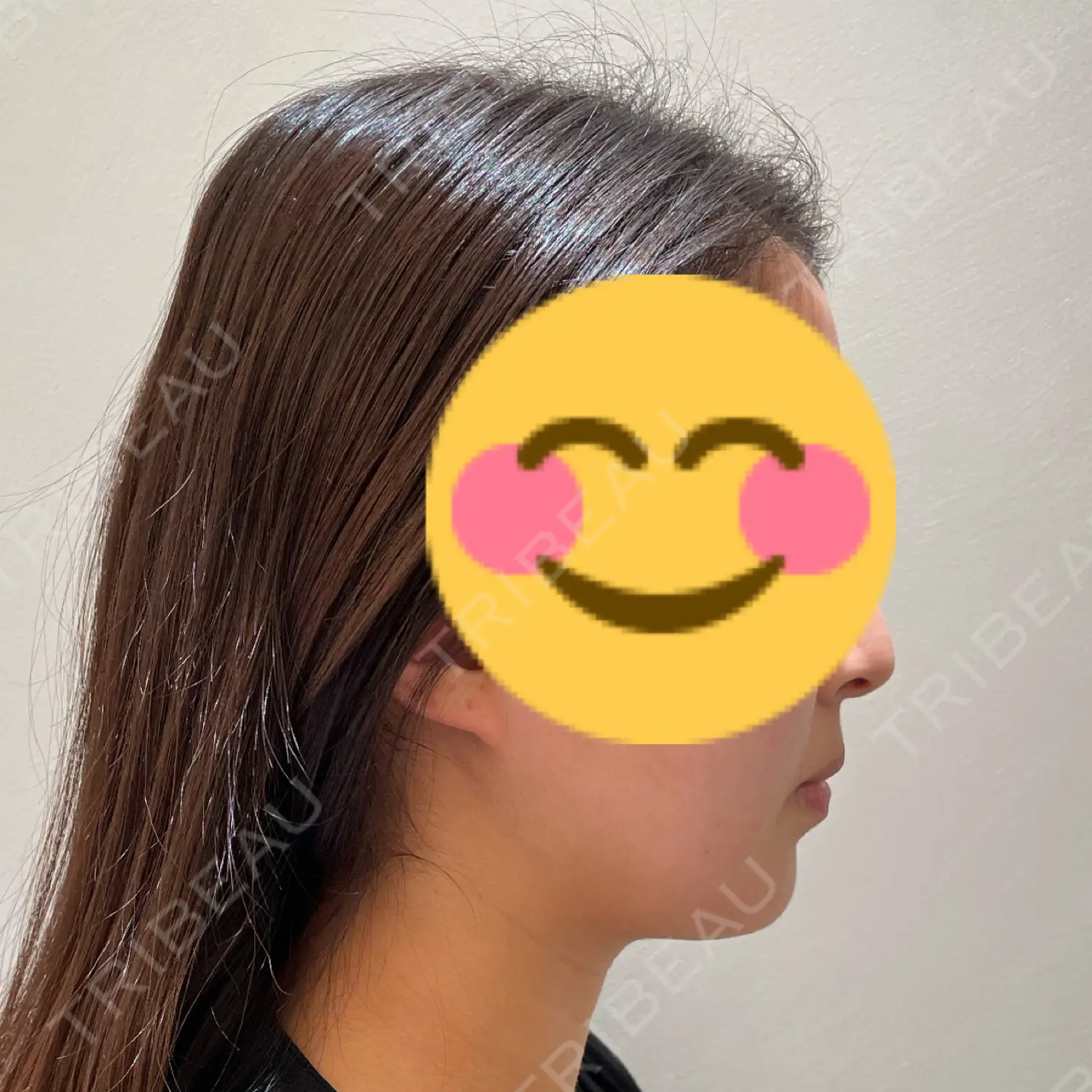 施術前の写真