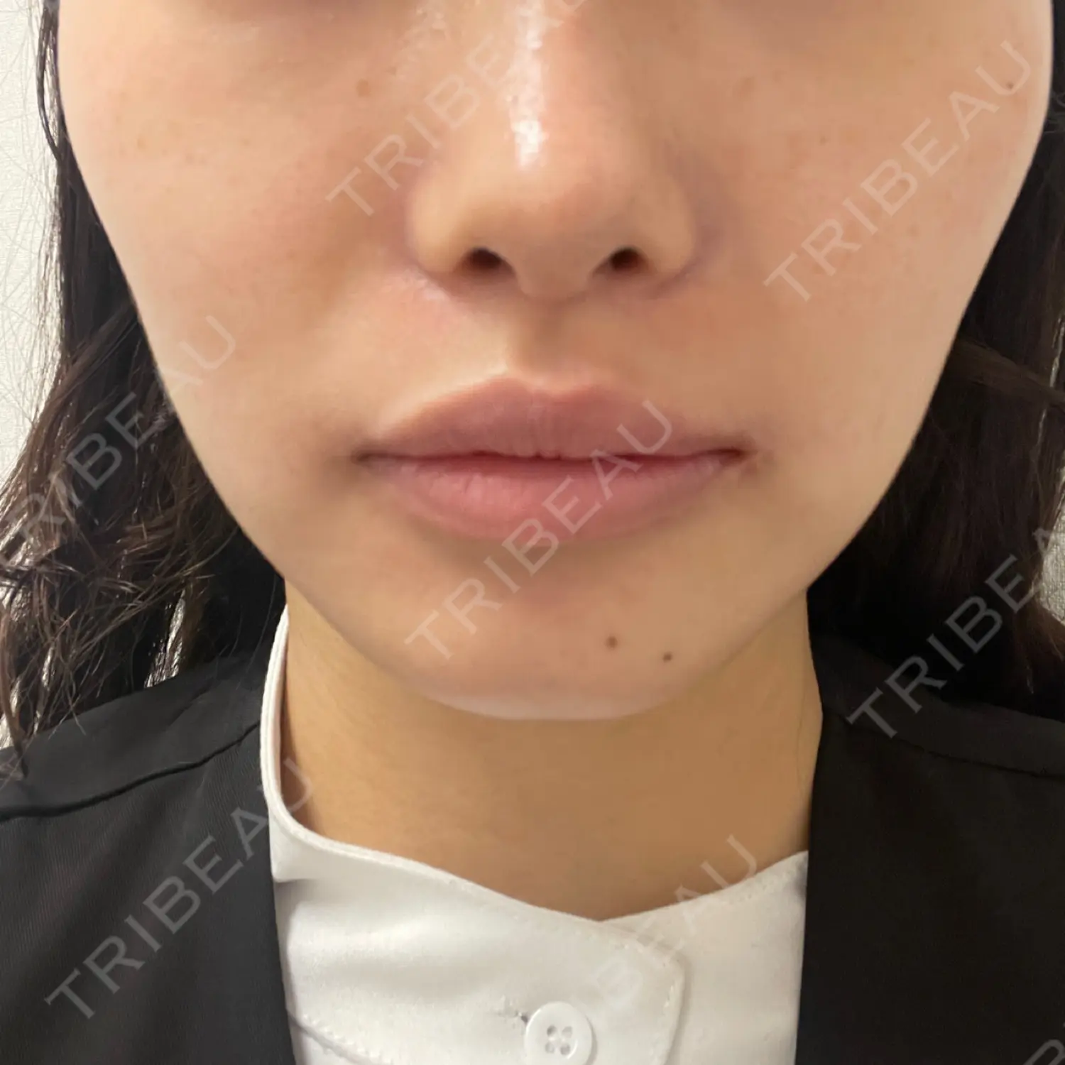 施術前の写真