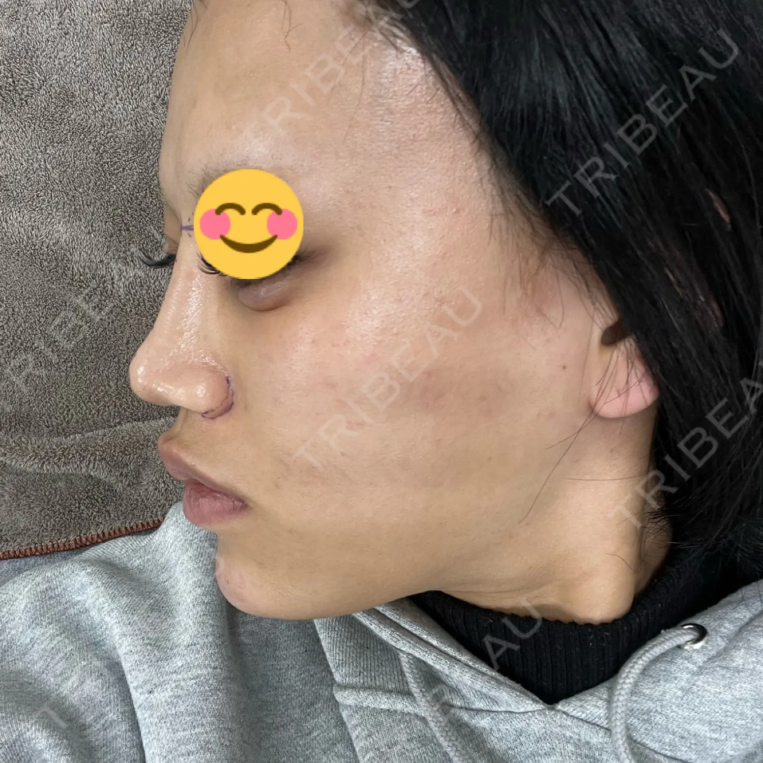 施術前の写真