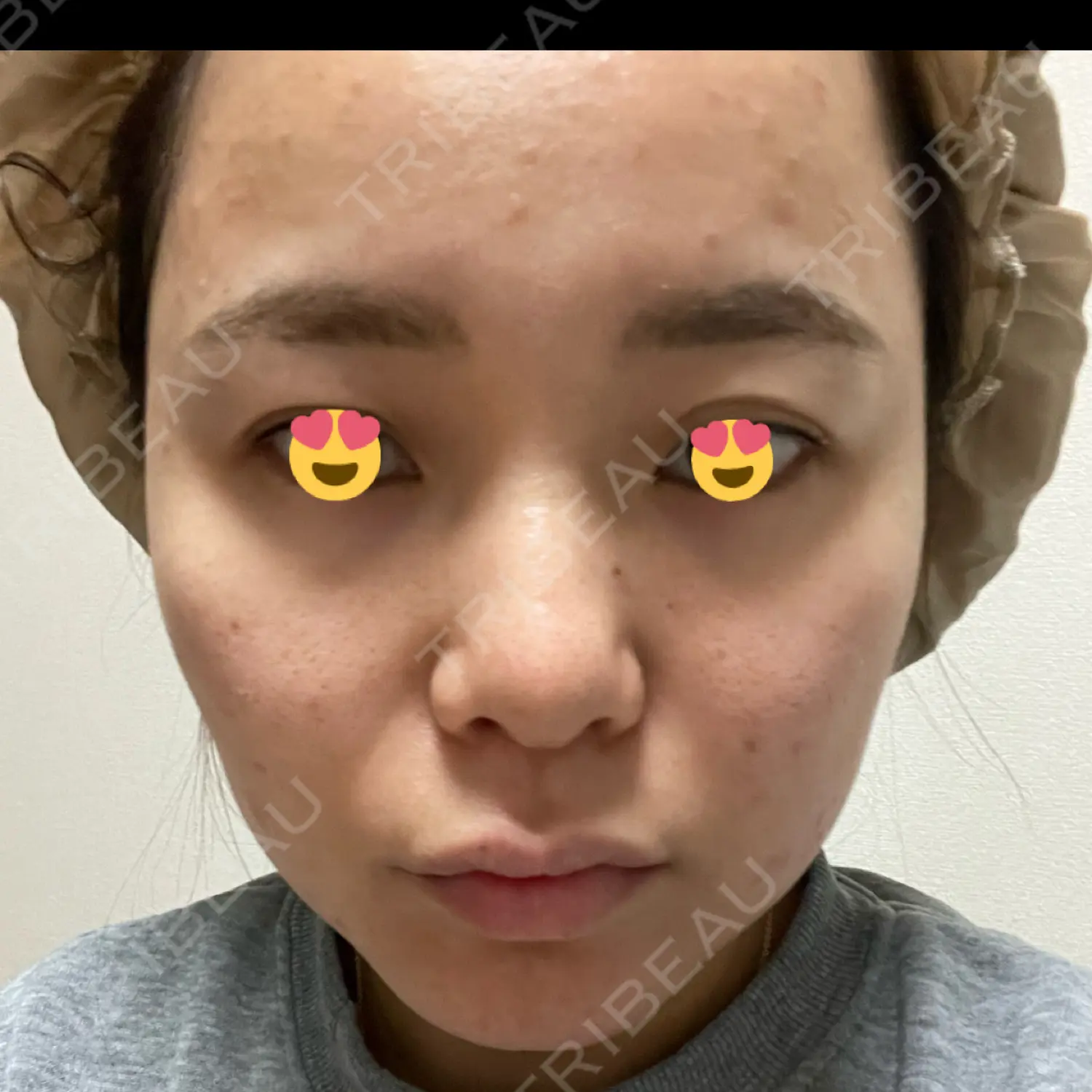 施術前の写真