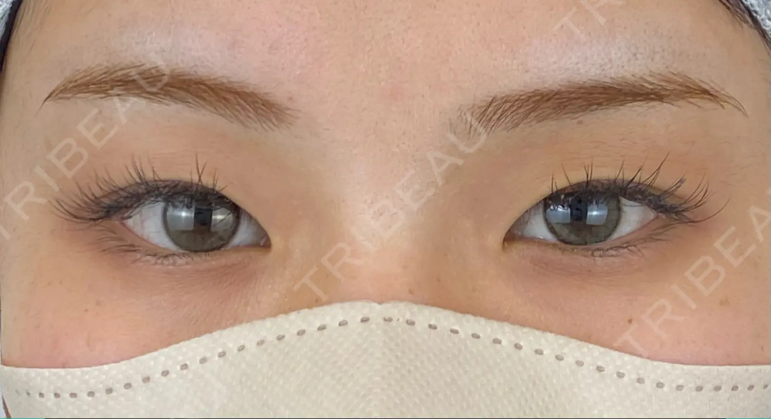 施術前の写真