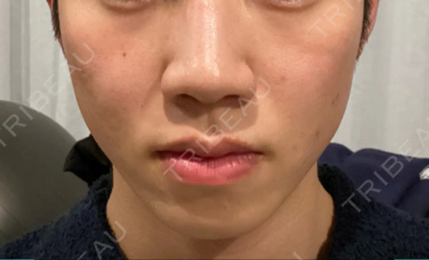 施術前の写真