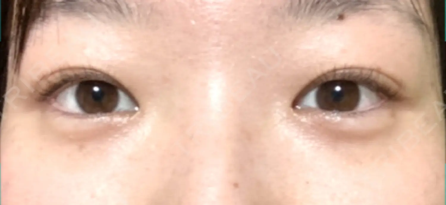 施術前の写真