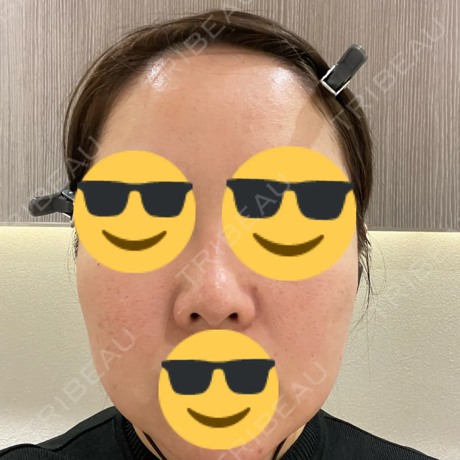 施術前の写真