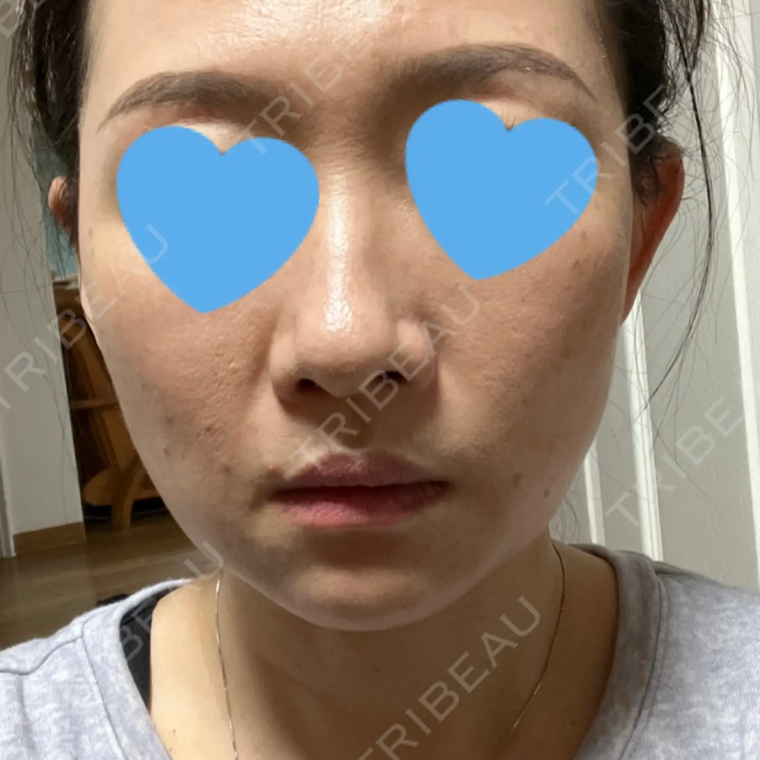 施術前の写真