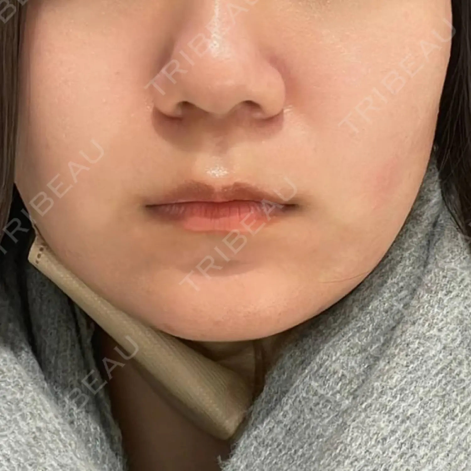 施術前の写真