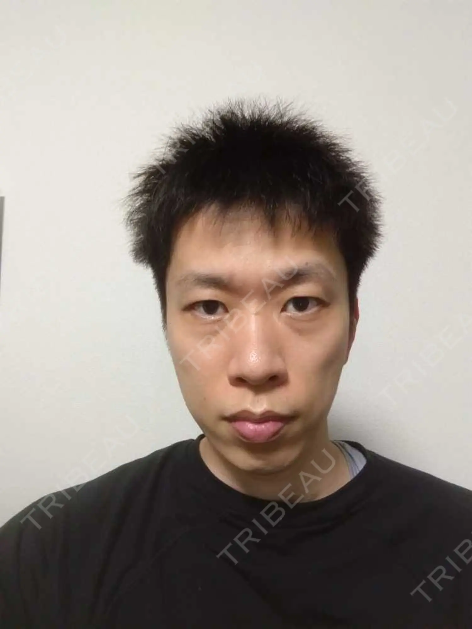 施術前の写真