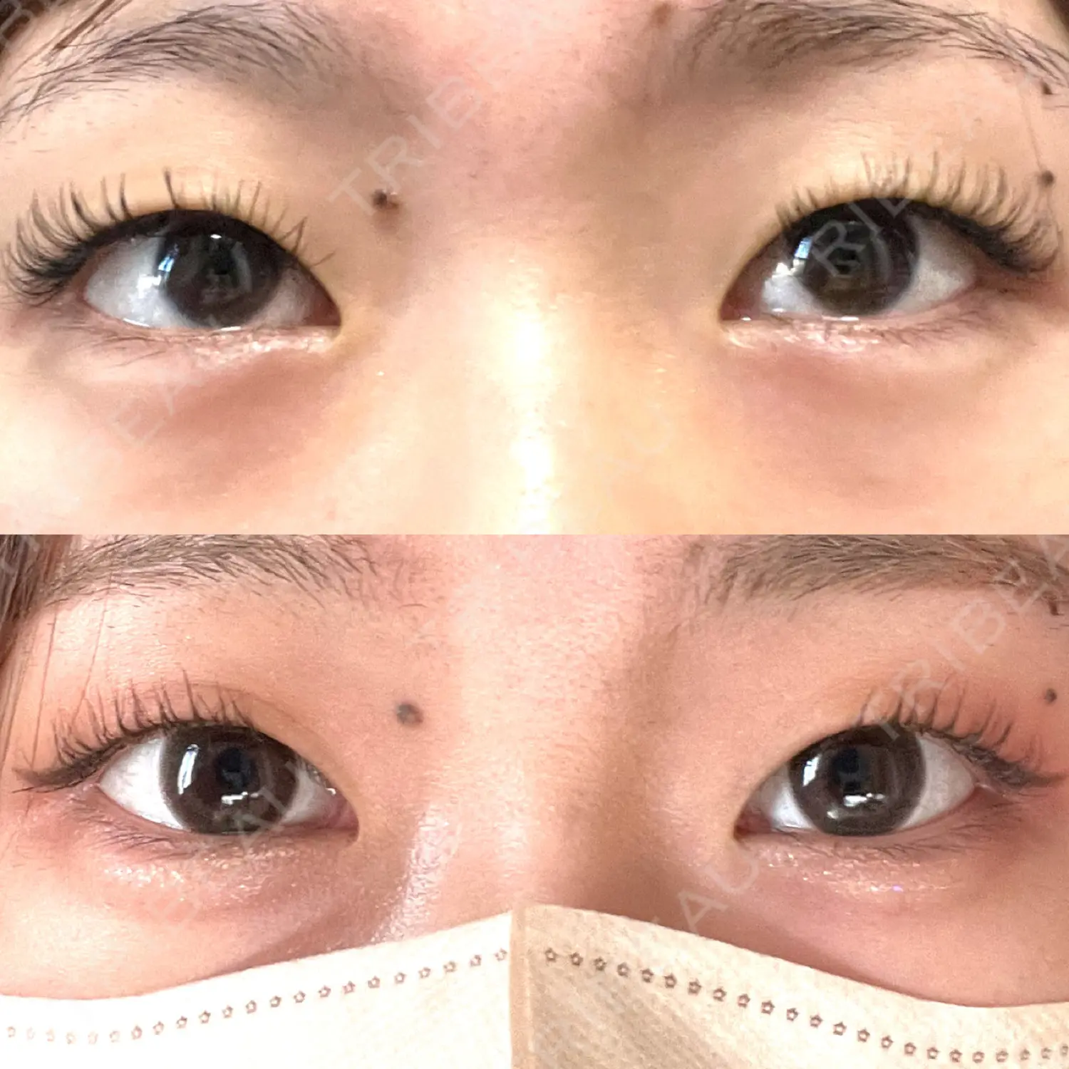 施術前の写真