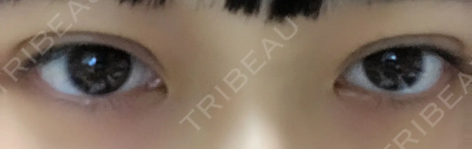 施術前の写真