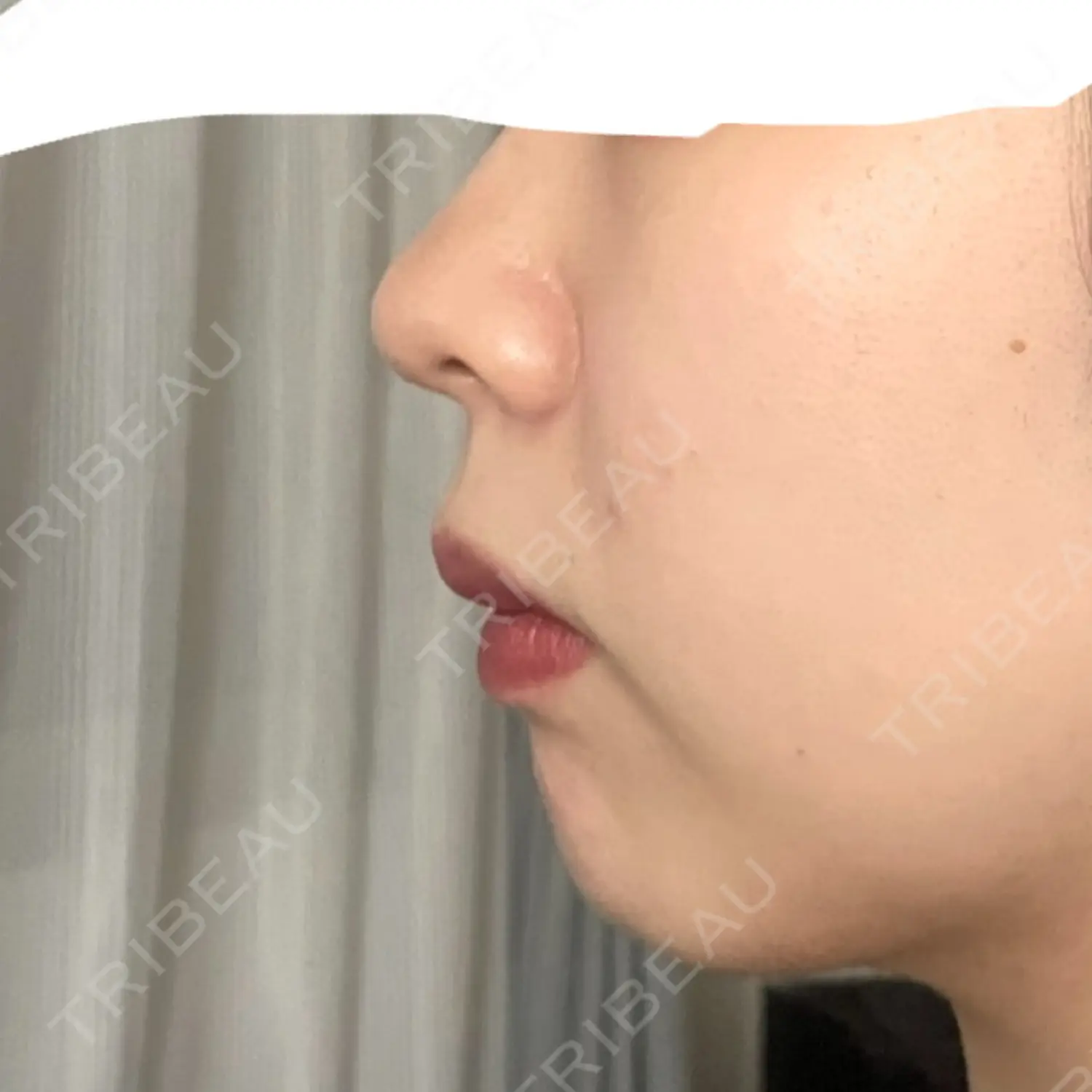 施術前の写真