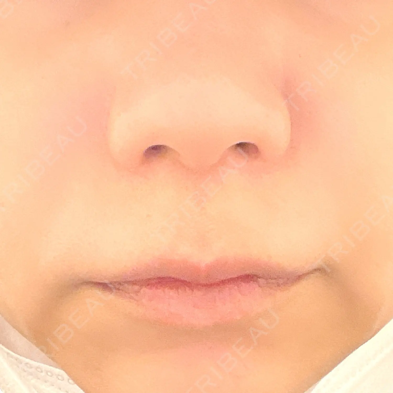 施術前の写真