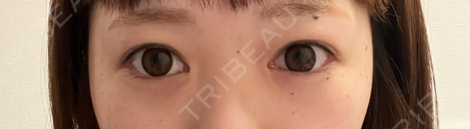 施術前の写真