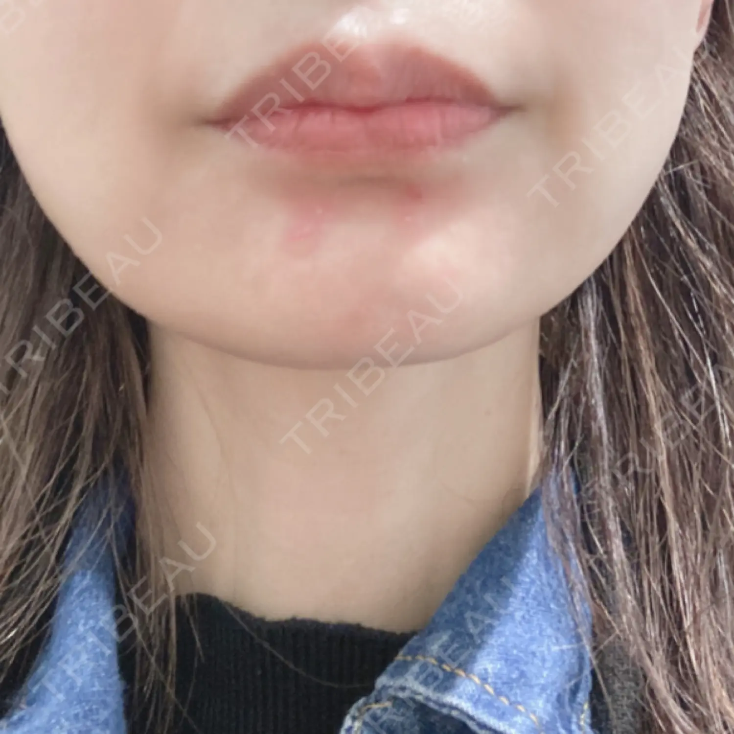 施術前の写真