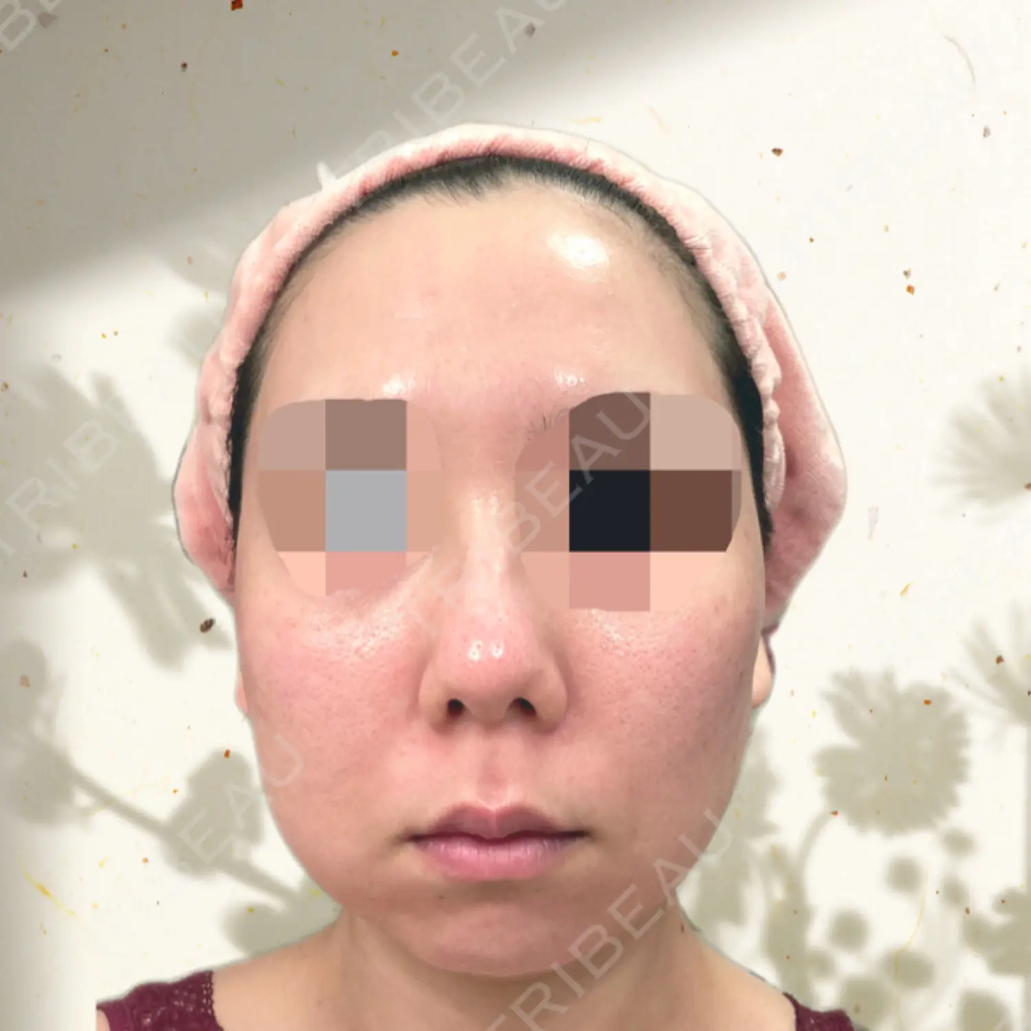 施術前の写真