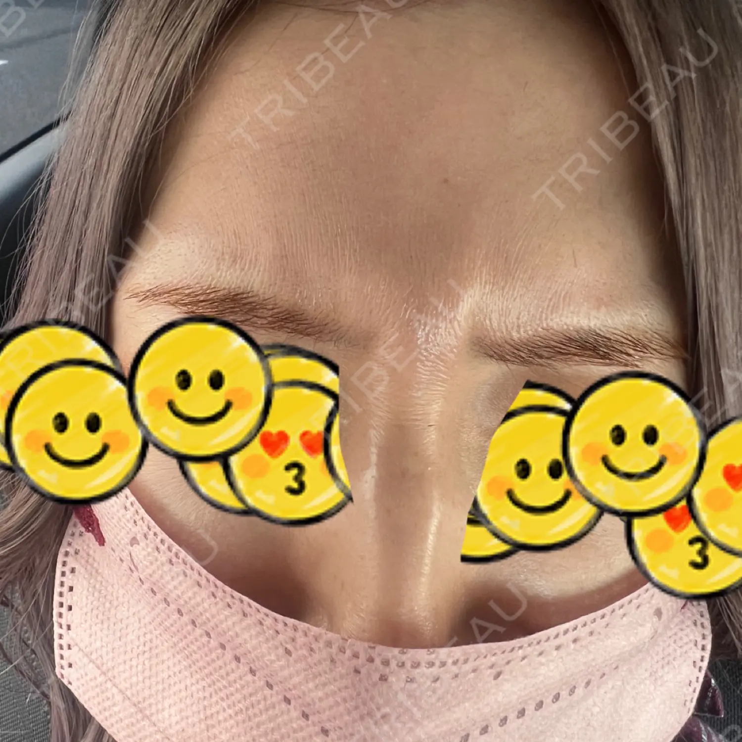 施術前の写真