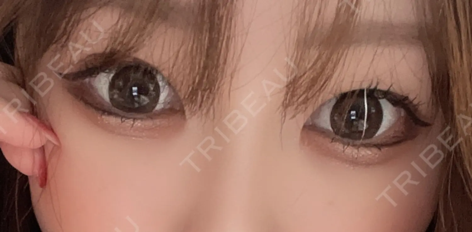 施術前の写真