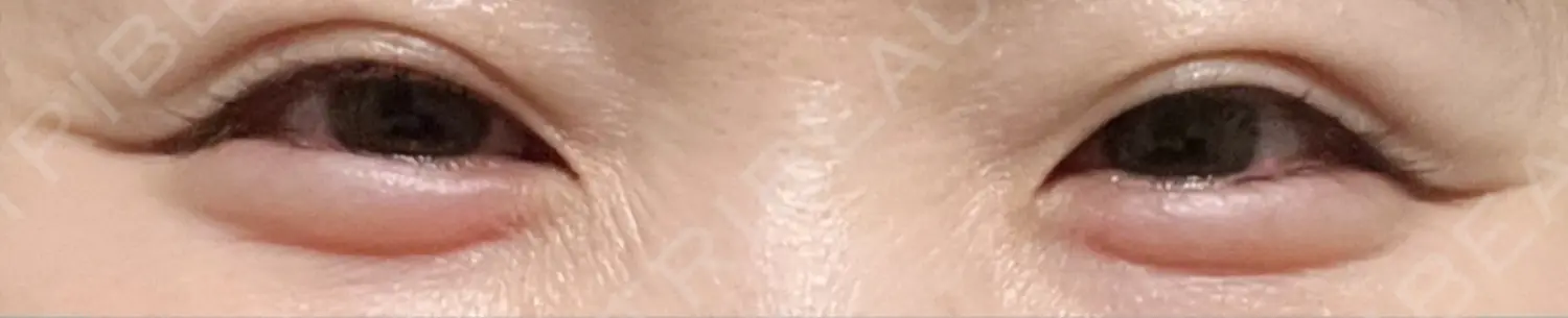 施術前の写真