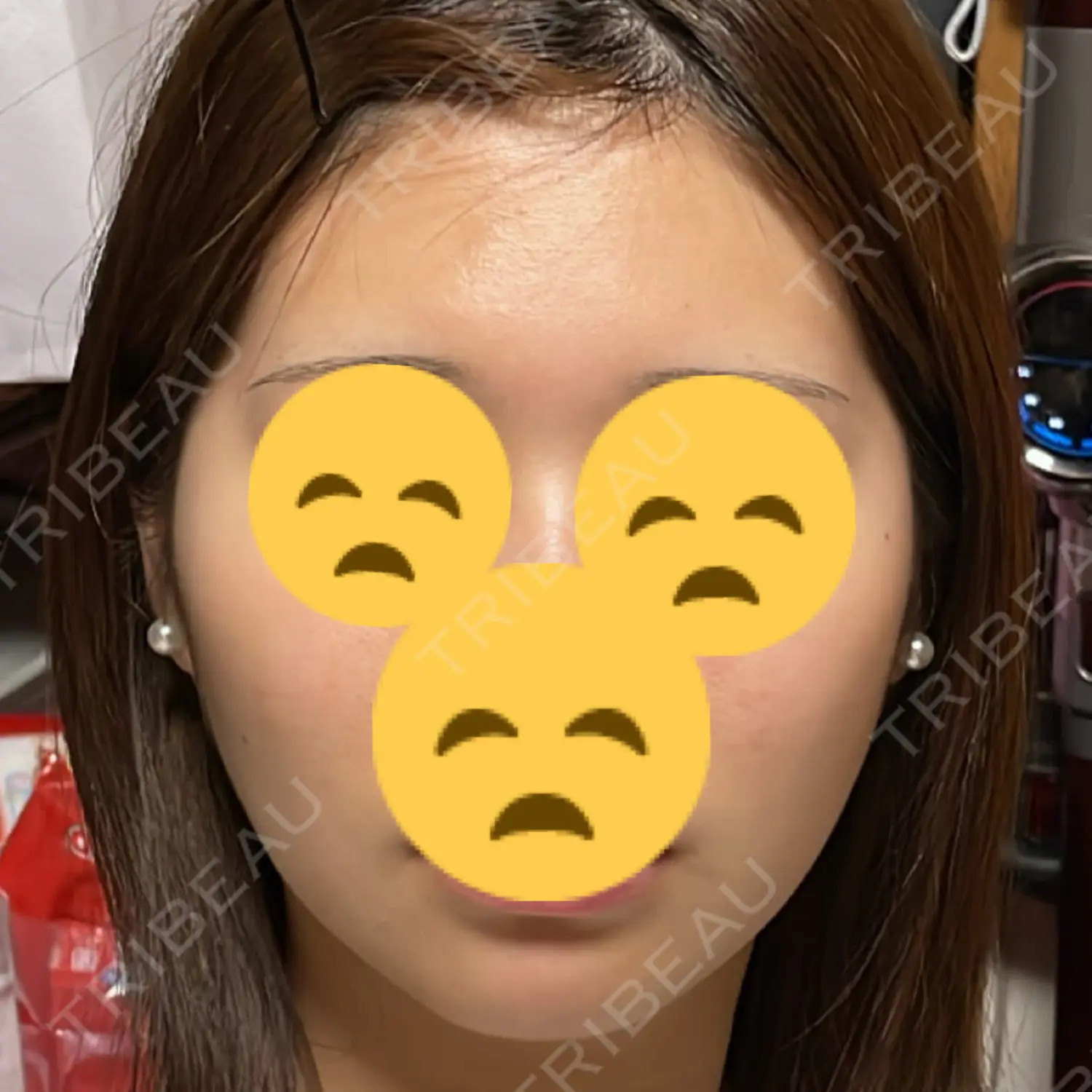 施術前の写真