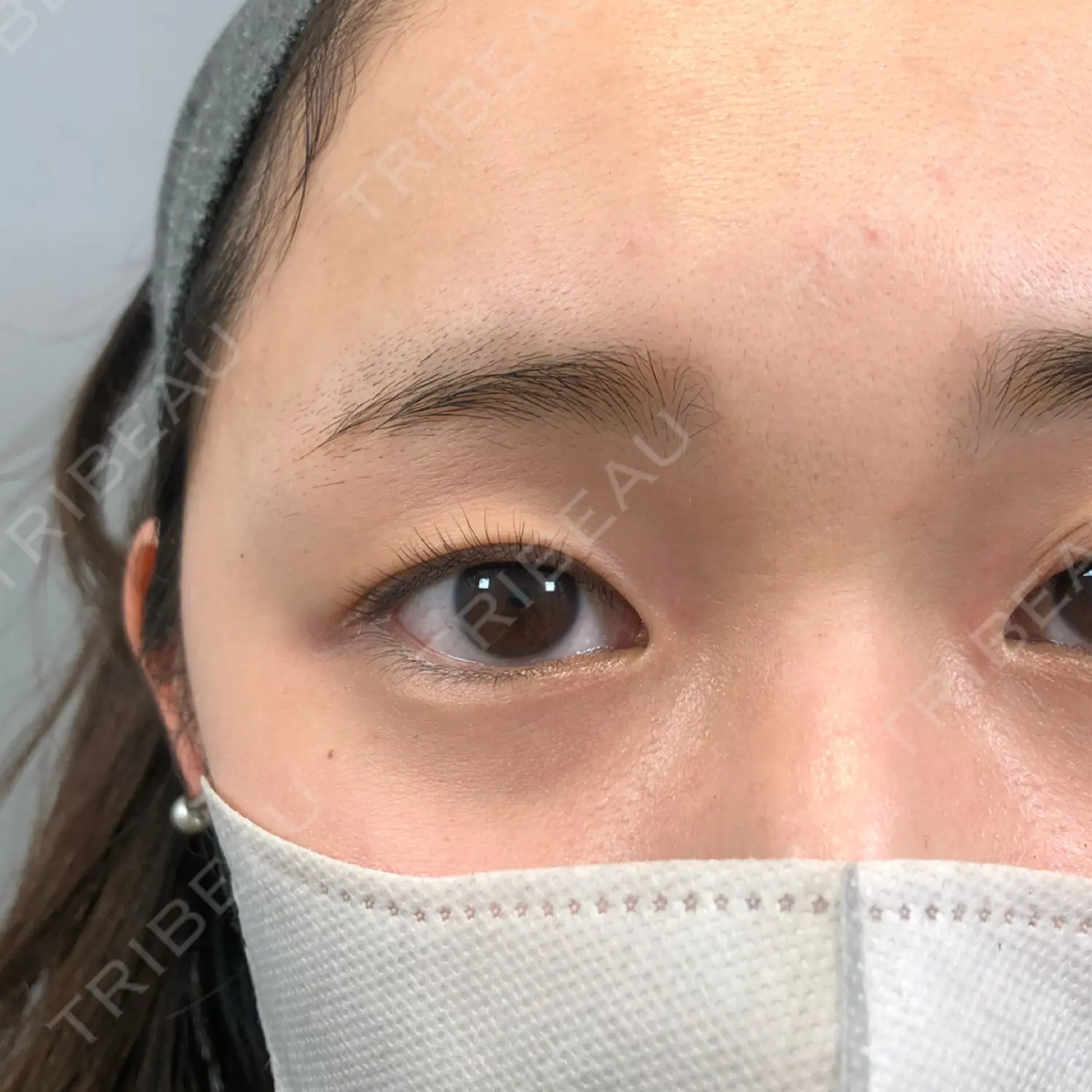 施術前の写真