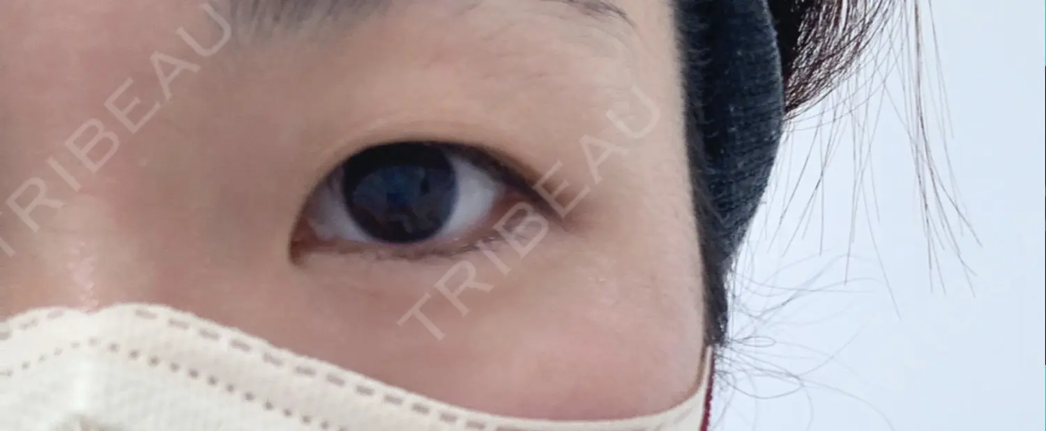 施術前の写真