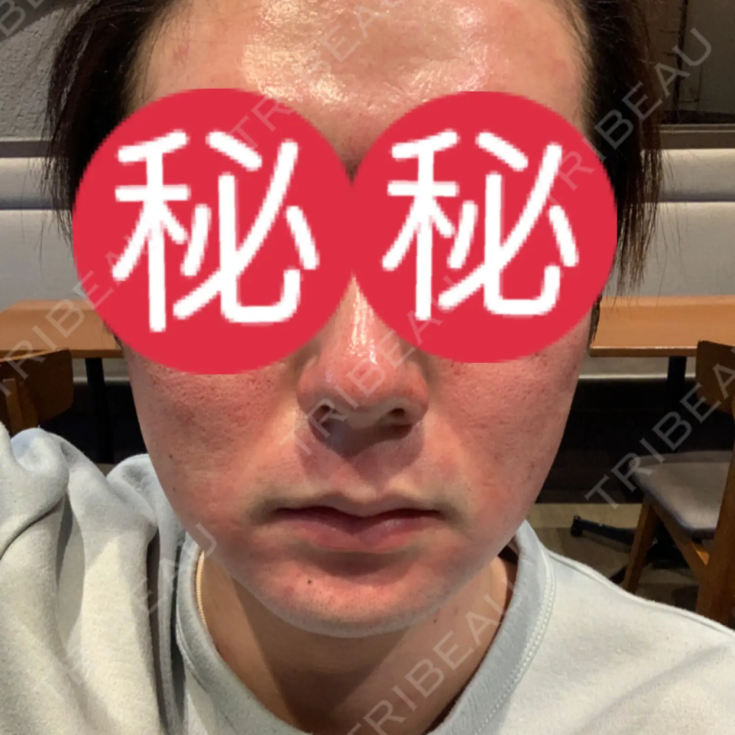 施術前の写真