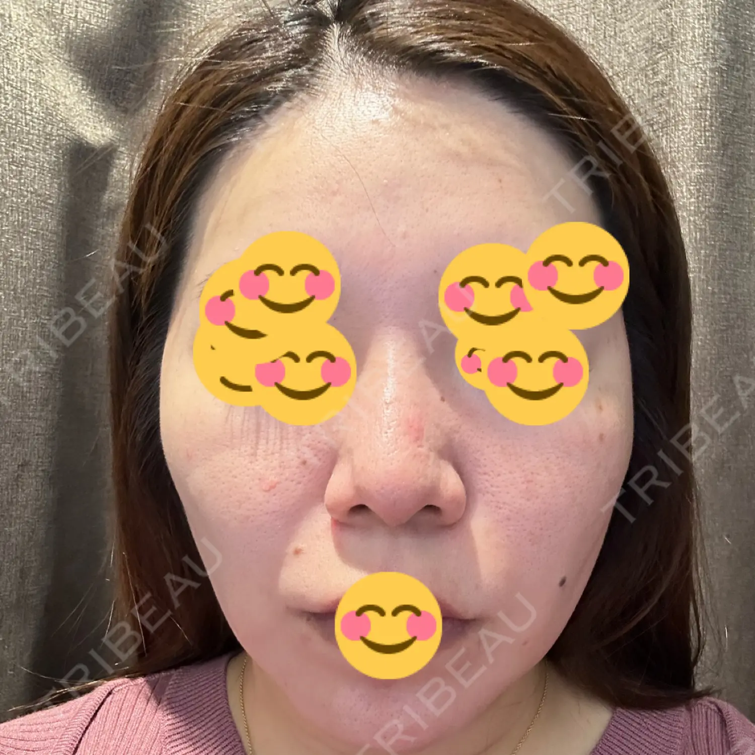 施術前の写真