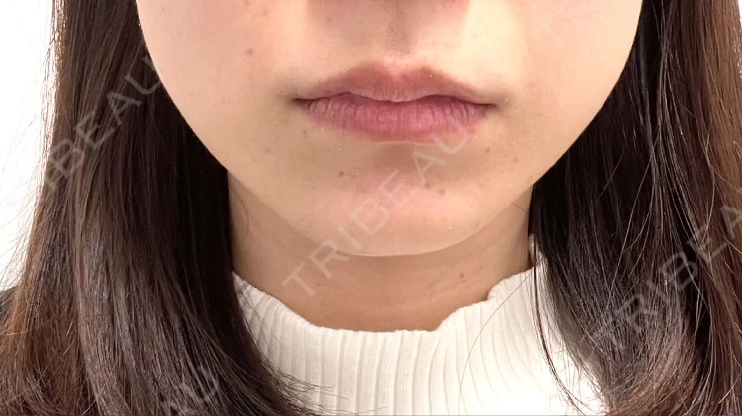 施術前の写真