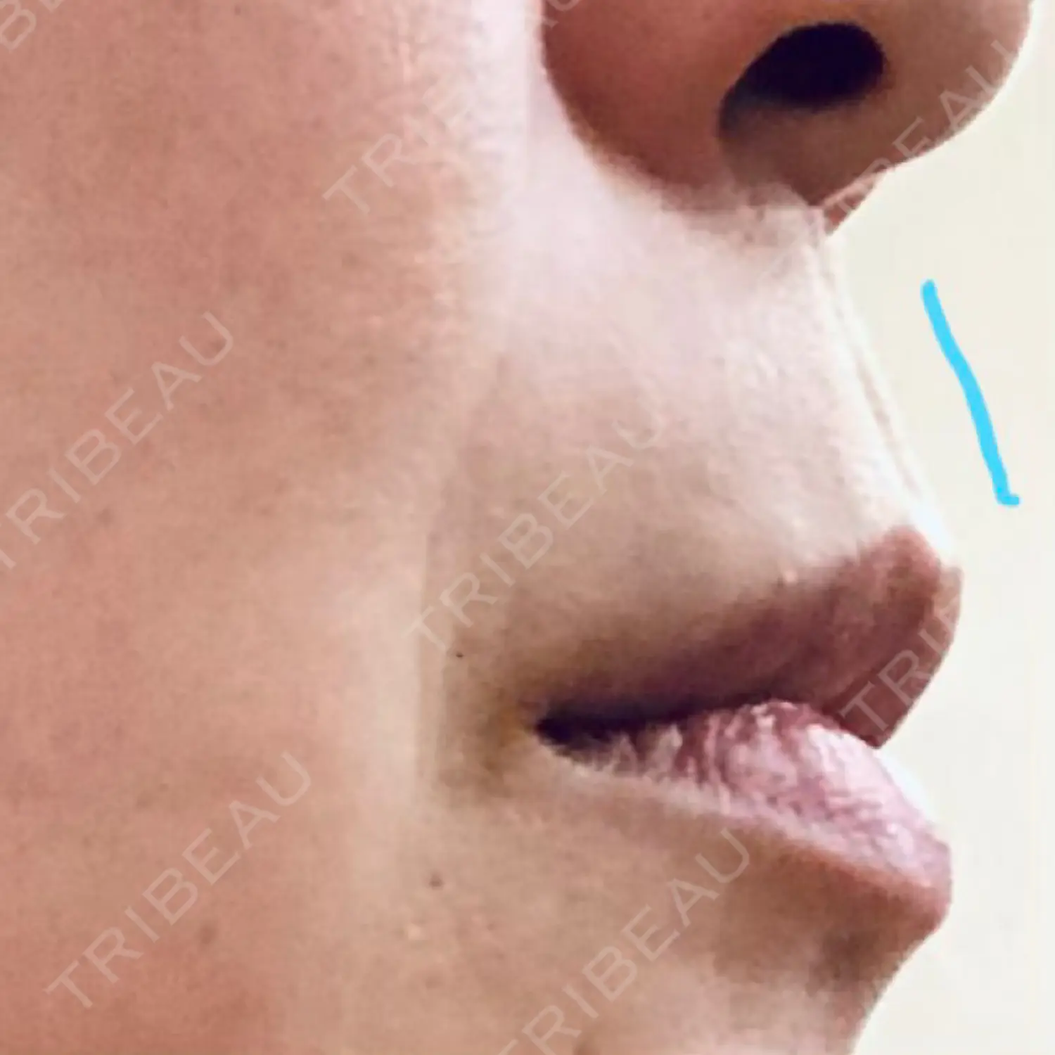 施術前の写真