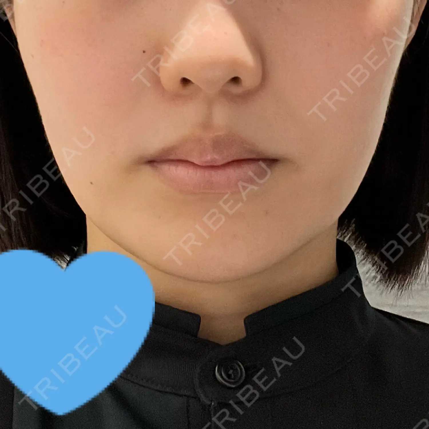 施術前の写真