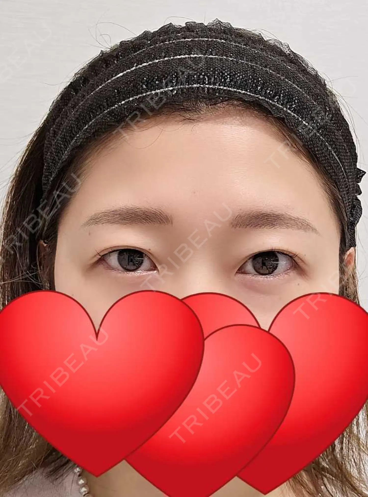 施術前の写真