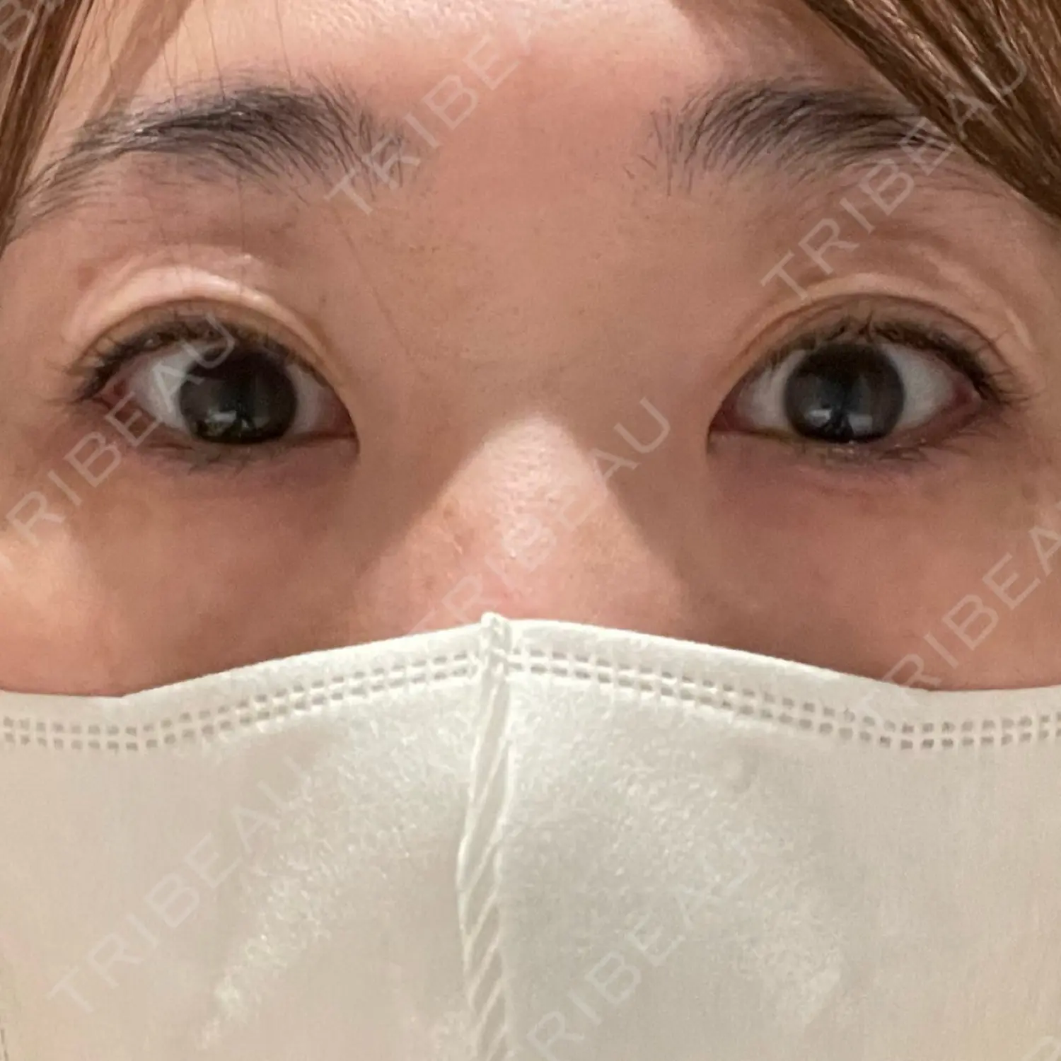 施術前の写真