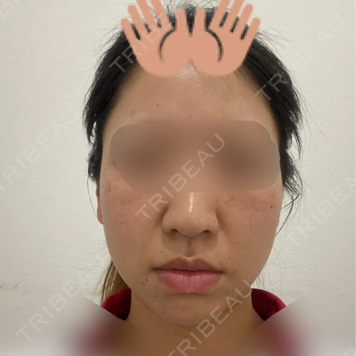 施術前の写真