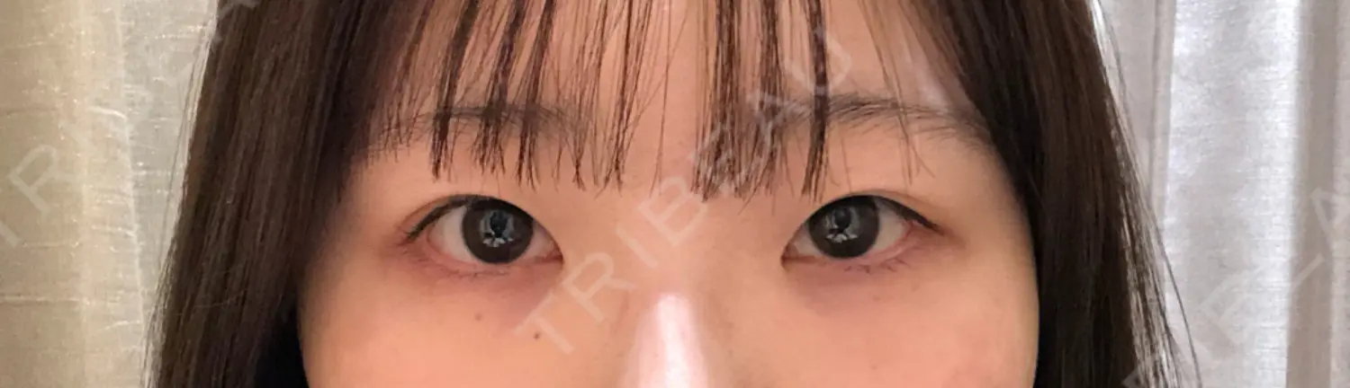 施術前の写真