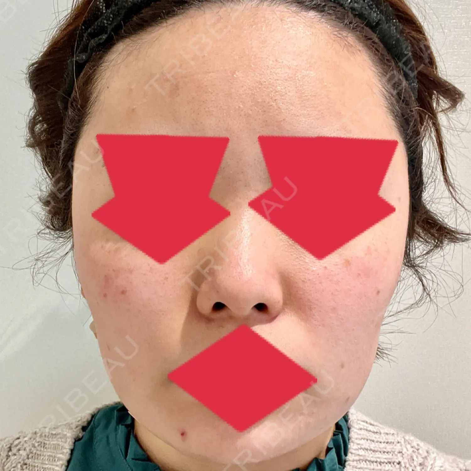 施術前の写真