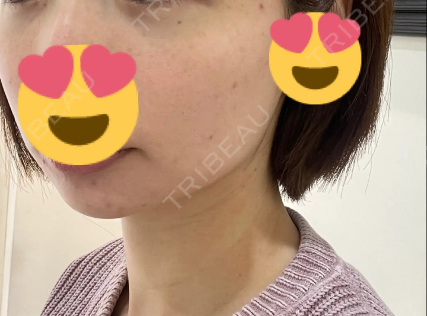 施術前の写真