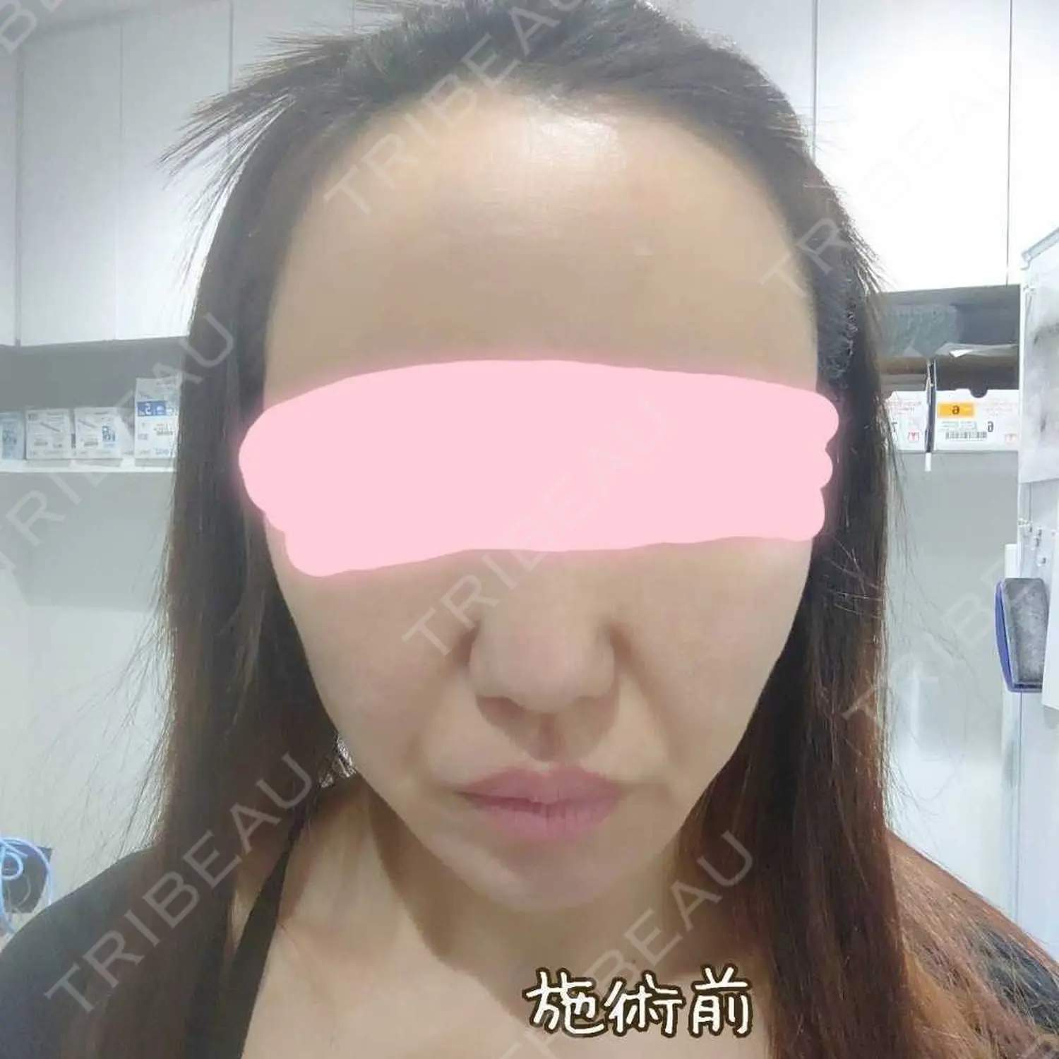 施術前の写真
