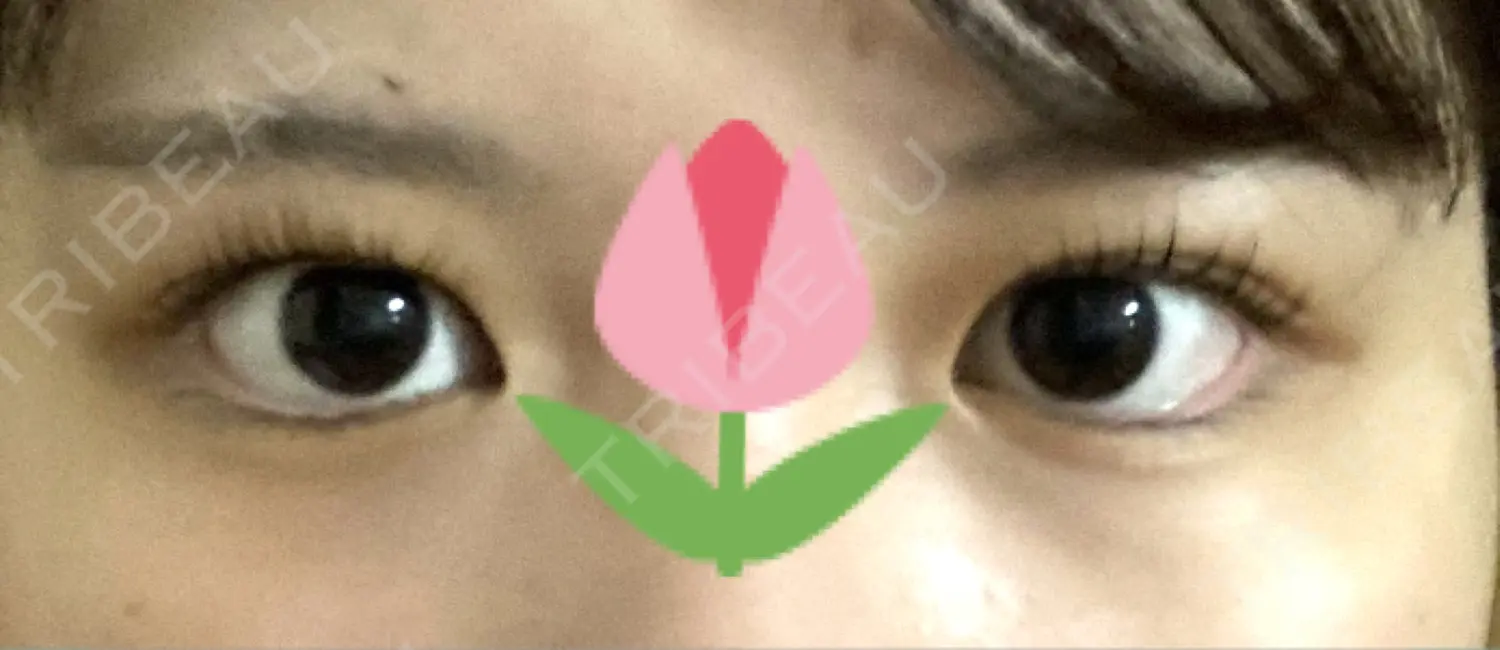 施術前の写真