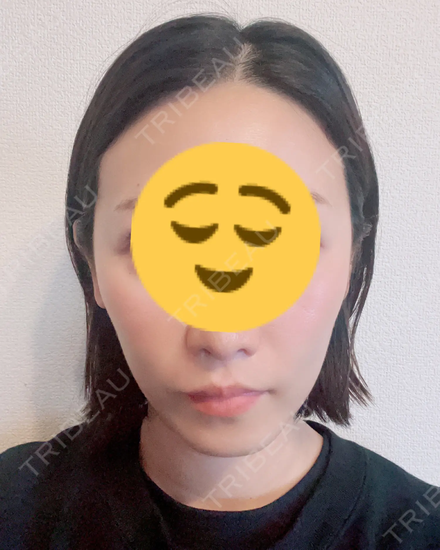 施術前の写真
