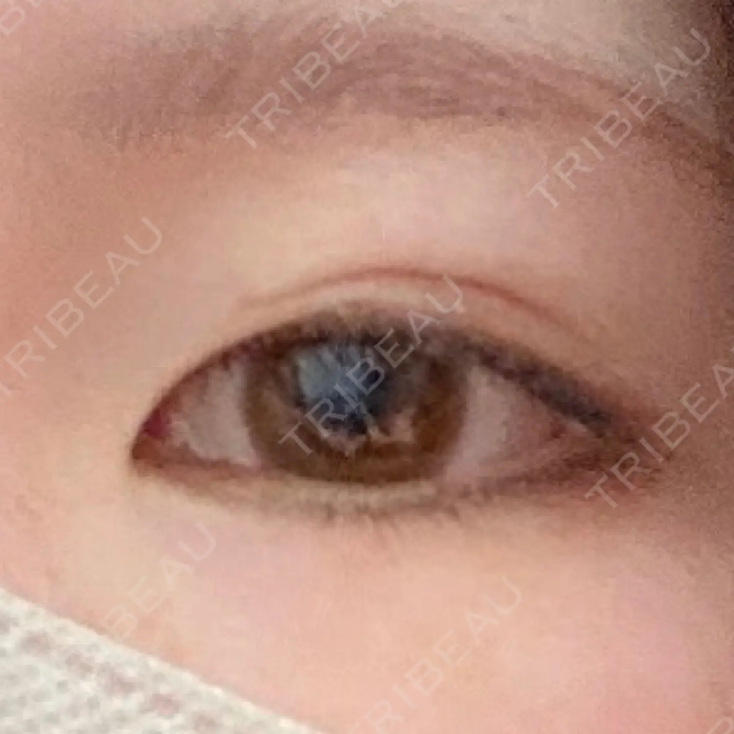 施術前の写真