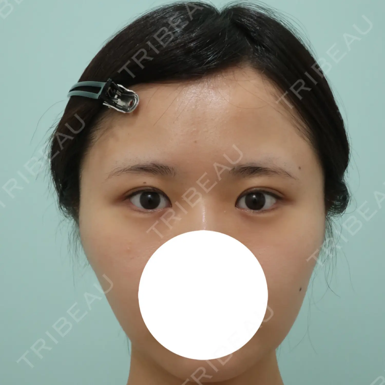 施術前の写真