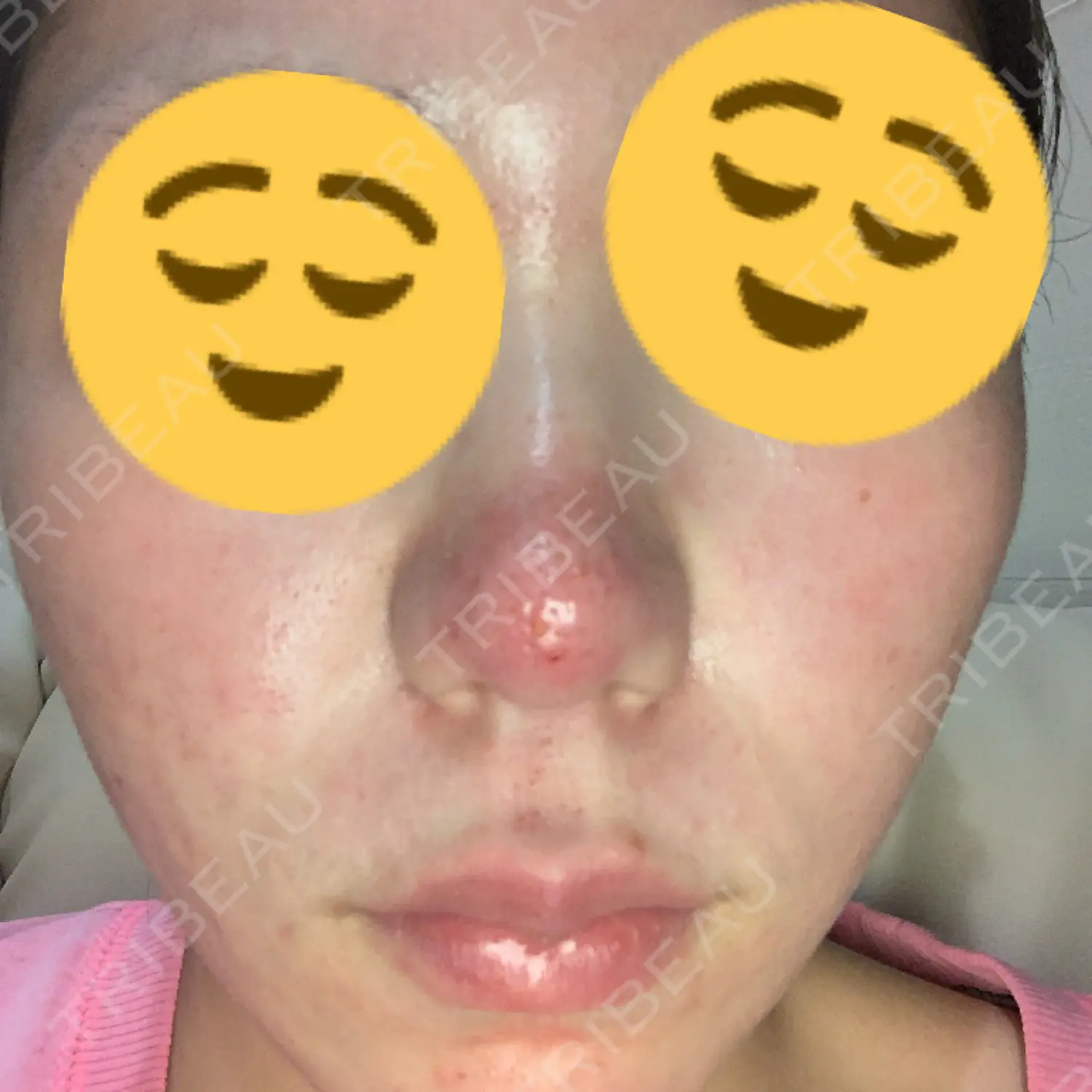 施術前の写真