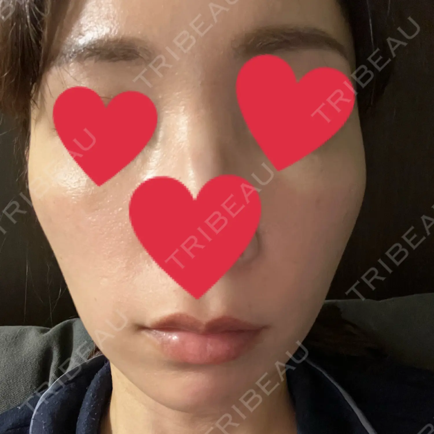 施術前の写真
