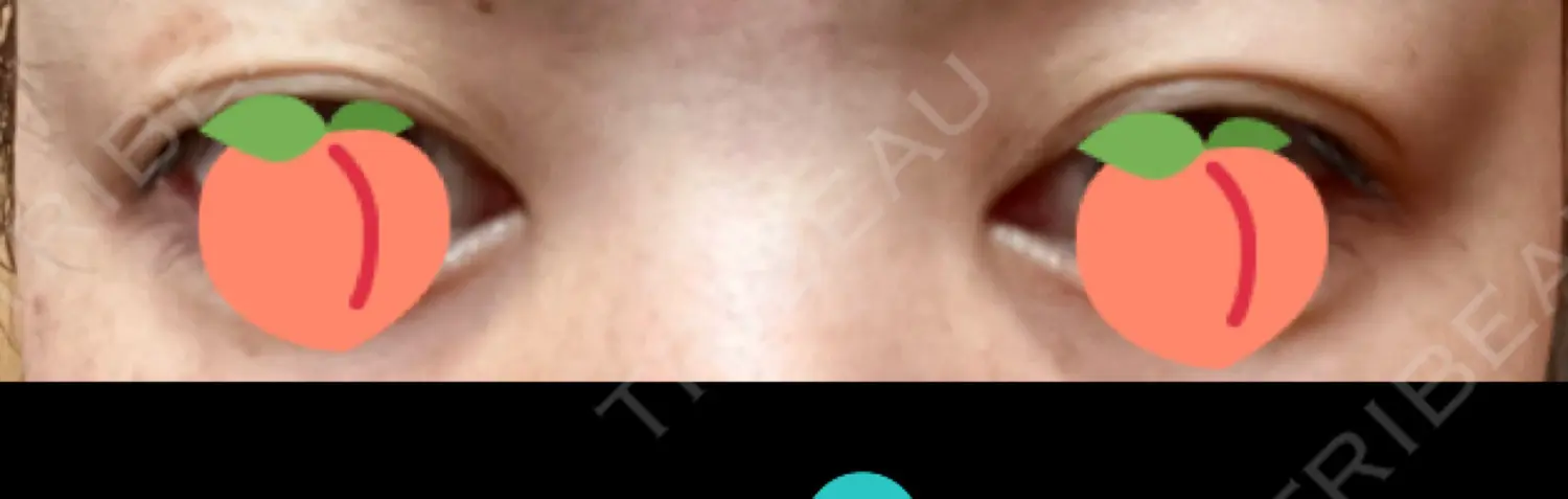 施術前の写真